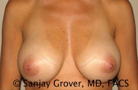 Breast Augmentation Before and After 183 | Sanjay Grover MD FACS