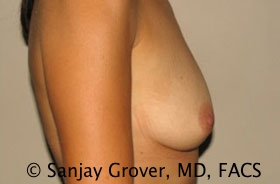 Breast Augmentation Before and After 183 | Grover Aesthetics