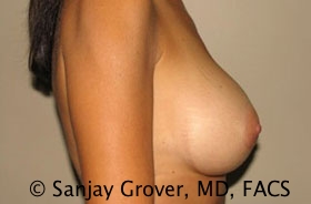 Breast Augmentation Before and After 183 | Grover Aesthetics