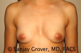 Breast Augmentation Before and After 235 | Sanjay Grover MD FACS