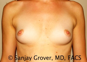 Breast Augmentation Before and After 313 | Sanjay Grover MD FACS