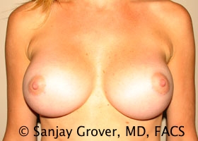 Breast Augmentation Before and After | Grover Aesthetics