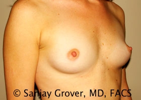 Breast Augmentation Before and After 184 | Grover Aesthetics