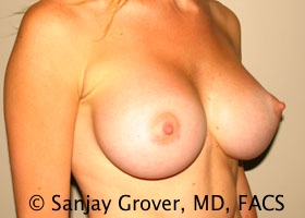Breast Augmentation Before and After 184 | Grover Aesthetics