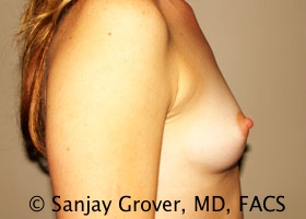 Breast Augmentation Before and After 184 | Grover Aesthetics