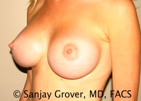 Breast Augmentation Before and After 184 | Grover Aesthetics