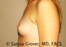 Breast Augmentation Before and After 184 | Grover Aesthetics