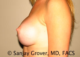 Breast Augmentation Before and After 184 | Grover Aesthetics