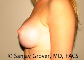 Breast Augmentation Before and After 184 | Sanjay Grover MD FACS