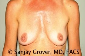 Breast Augmentation Before and After 263 | Sanjay Grover MD FACS