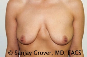 Breast Augmentation Before and After 300 | Sanjay Grover MD FACS