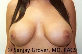 Breast Augmentation Before and After | Grover Aesthetics