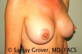Breast Augmentation Before and After 185 | Sanjay Grover MD FACS