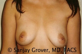 Breast Augmentation Before and After 15 | Sanjay Grover MD FACS