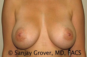 Breast Augmentation Before and After | Grover Aesthetics