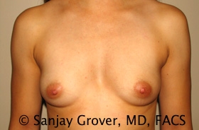 Breast Augmentation Before and After 195 | Sanjay Grover MD FACS