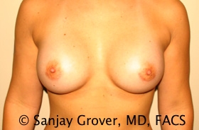 Breast Augmentation Before and After 187 | Sanjay Grover MD FACS