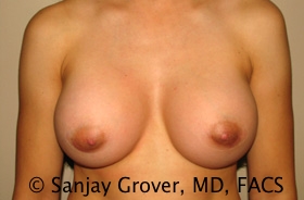 Breast Augmentation Before and After | Sanjay Grover MD FACS