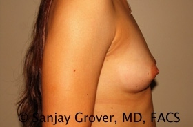 Breast Augmentation Before and After 187 | Grover Aesthetics