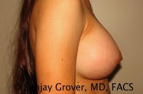Breast Augmentation Before and After 187 | Grover Aesthetics