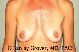 Breast Augmentation Before and After | Grover Aesthetics