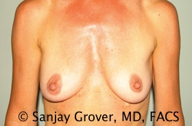 Breast Augmentation Before and After 266 | Sanjay Grover MD FACS