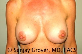 Breast Augmentation Before and After | Grover Aesthetics