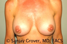 Breast Augmentation Before and After | Sanjay Grover MD FACS