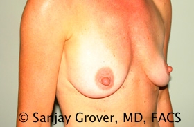 Breast Augmentation Before and After 188 | Grover Aesthetics