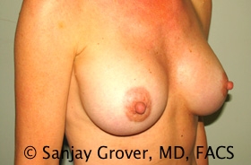 Breast Augmentation Before and After 188 | Grover Aesthetics