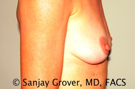 Breast Augmentation Before and After 188 | Grover Aesthetics