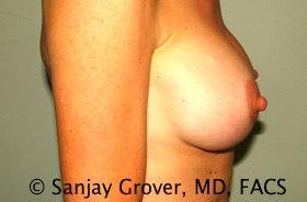 Breast Augmentation Before and After 188 | Sanjay Grover MD FACS