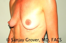 Breast Augmentation Before and After 188 | Sanjay Grover MD FACS