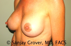 Breast Augmentation Before and After 188 | Grover Aesthetics