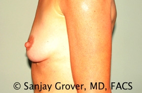 Breast Augmentation Before and After 188 | Grover Aesthetics