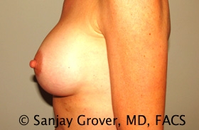 Breast Augmentation Before and After 188 | Grover Aesthetics