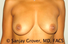 Breast Augmentation Before and After | Grover Aesthetics