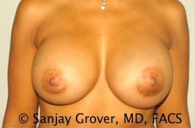Breast Augmentation Before and After | Grover Aesthetics