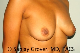 Breast Augmentation Before and After 189 | Grover Aesthetics