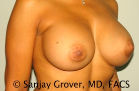 Breast Augmentation Before and After 189 | Grover Aesthetics