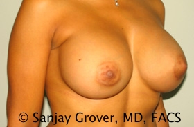 Breast Augmentation Before and After 189 | Sanjay Grover MD FACS