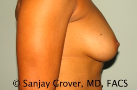 Breast Augmentation Before and After 189 | Grover Aesthetics