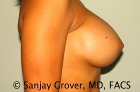 Breast Augmentation Before and After 189 | Grover Aesthetics