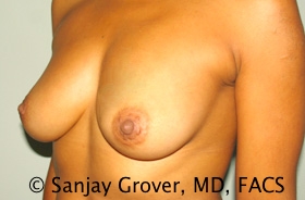Breast Augmentation Before and After 189 | Grover Aesthetics