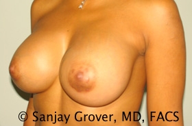 Breast Augmentation Before and After 189 | Grover Aesthetics