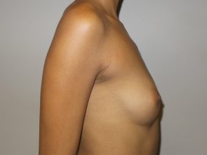 Breast Augmentation Before and After 19 | Grover Aesthetics