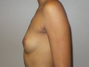 Breast Augmentation Before and After 19 | Grover Aesthetics