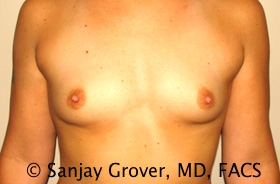 Breast Augmentation Before and After | Sanjay Grover MD FACS