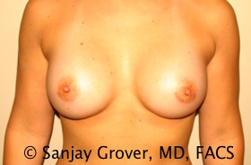 Breast Augmentation Before and After | Grover Aesthetics