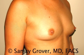 Breast Augmentation Before and After 190 | Grover Aesthetics